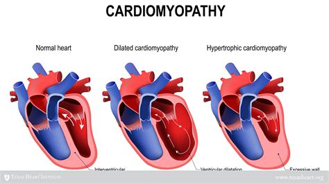 mildly dilated left ventricle treatment